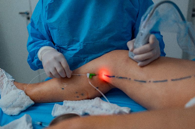 Endolaser para tratamento minimamente invasivo de varizes