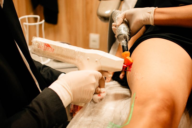 Close-up de pernas com vasinhos visíveis na pele, destacando telangiectasias em tons arroxeados e vermelhos 