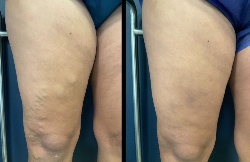 Close-up de procedimento de tratamento de varizes com laser endovenoso em perna masculina em clínica médica moderna 