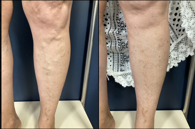 Médico aplicando escleroterapia com espuma em veia das pernas de paciente em clínica moderna em Recife 