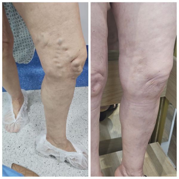 Comparação visual entre tratamento endolaser ATTA e cirurgia tradicional para varizes nas pernas humanas, mostrando técnica minimamente invasiva e cirurgia com cortes e internação 