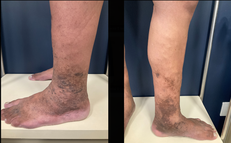 Homem olhando para as pernas destacando veias varicosas visíveis 