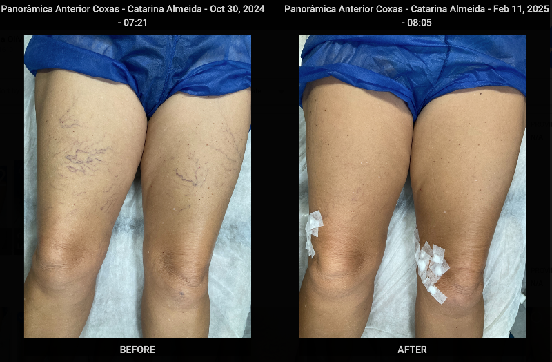 Pernambuco: close-up de pernas com varizes grossas e vasinhos finos visíveis na pele 