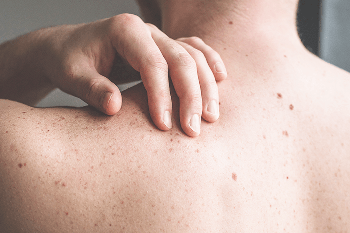 Dermatologista examinando pele de paciente ao ar livre com proteção solar no Dezembro Laranja 