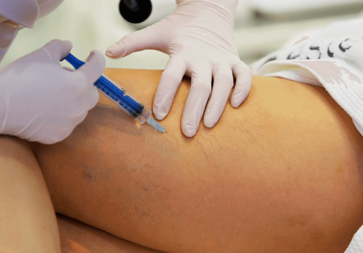 Médico realizando escleroterapia líquida com glicose em vasinhos na perna de uma paciente 