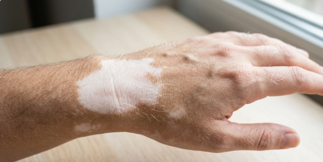 Detalhe de cabelos e sobrancelha com mecha branca típica de poliose em pessoa com vitiligo 